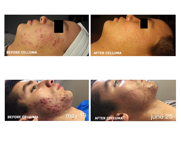 Celluma Light Therapy