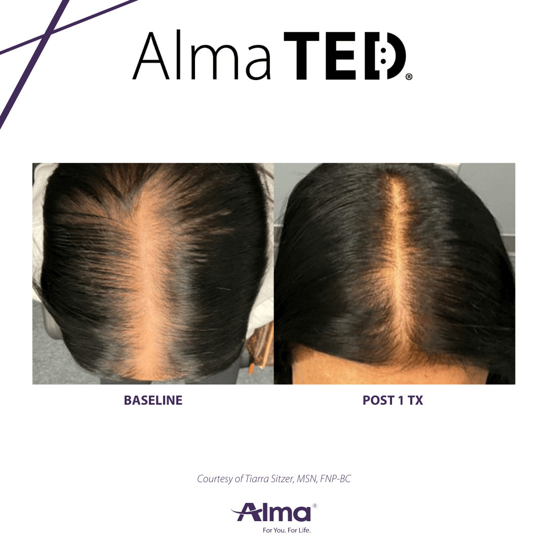 Before_After_TED-1 Before_After_TED-1