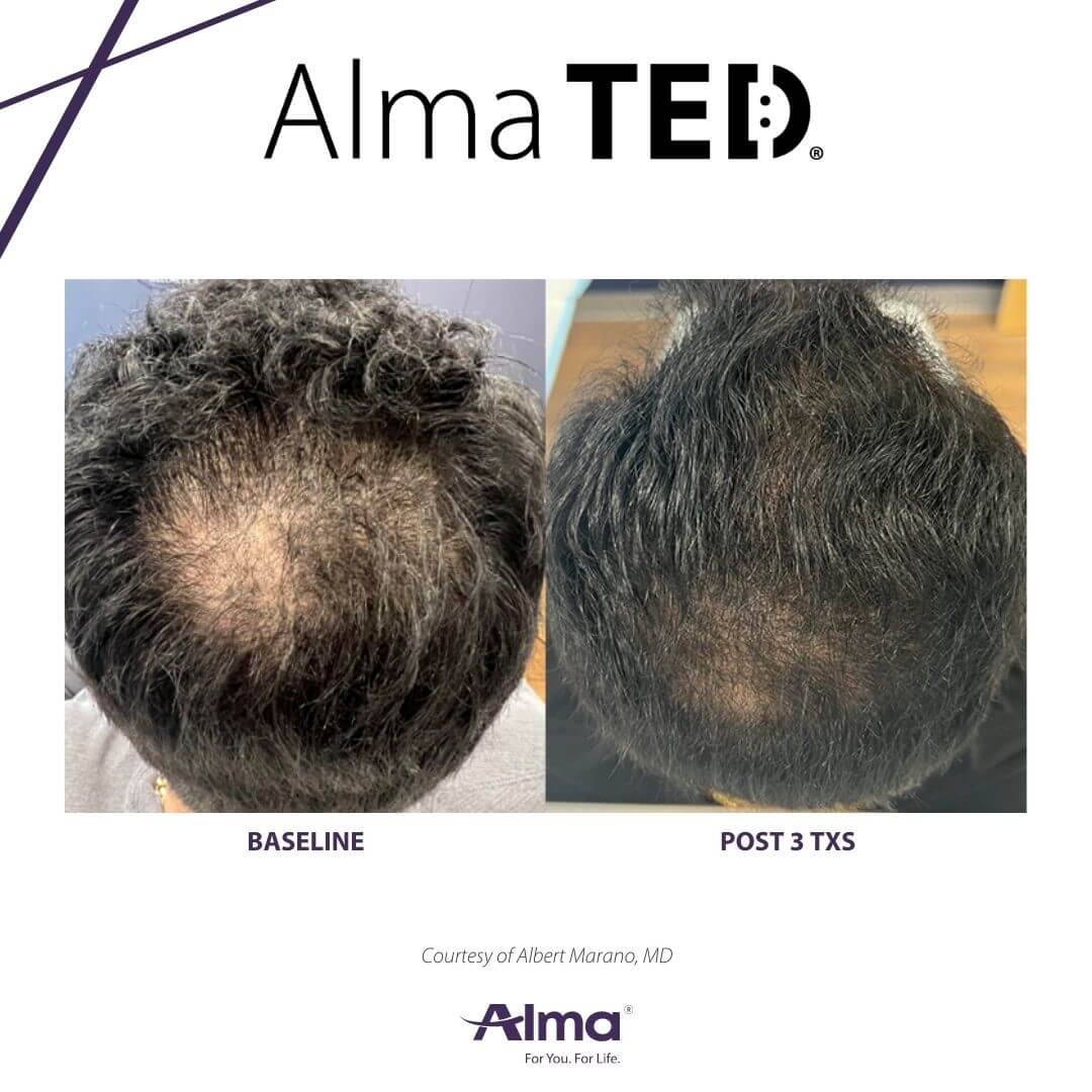TED-Before_After-1 TED-Before_After-1