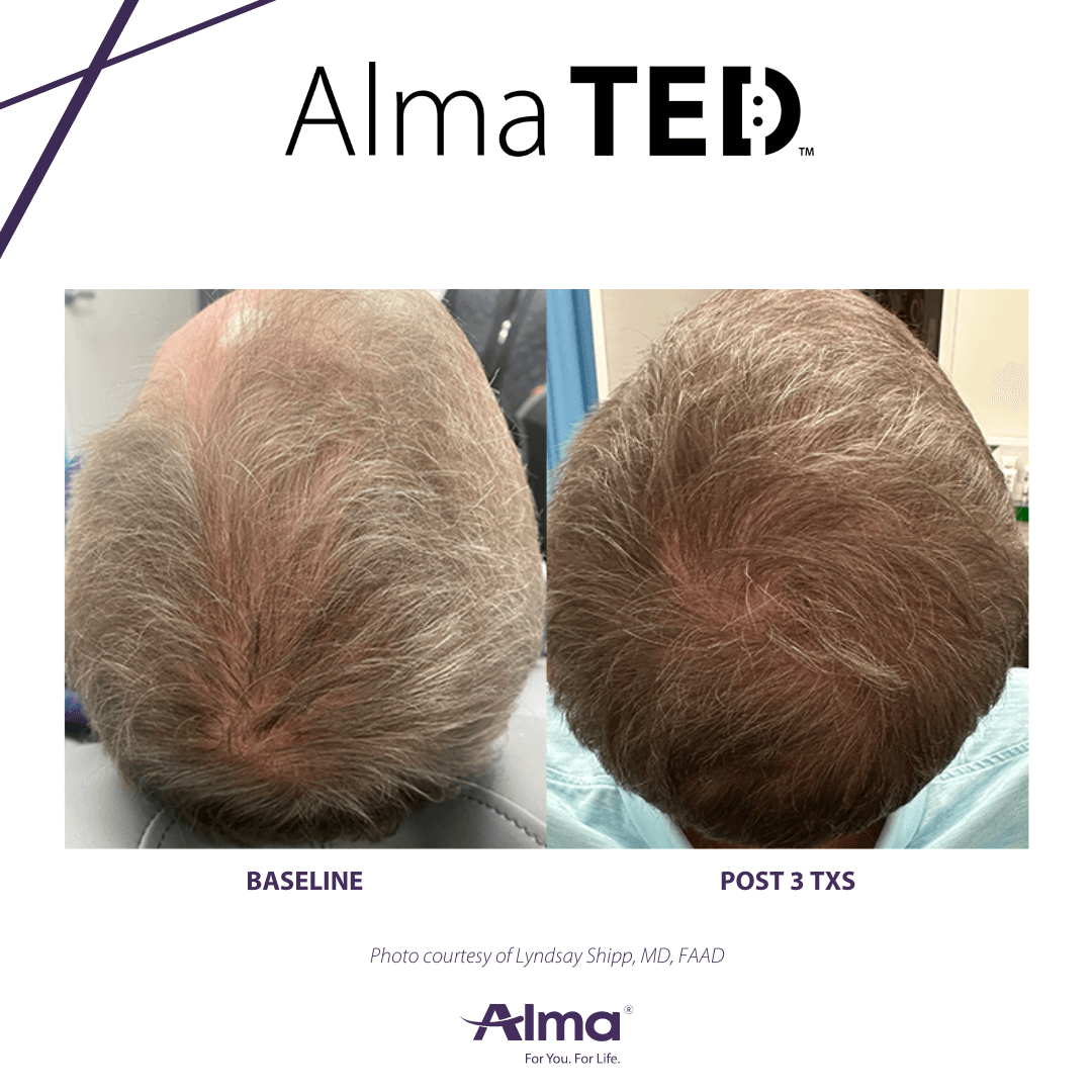 TED-Before_After2-1 TED-Before_After2-1